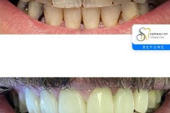 IMG_0927-Before-After