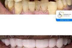 IMG_0928-Before-After