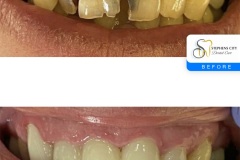 IMG_1366-Before-After