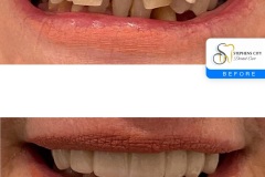 IMG_1622-Before-After