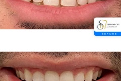 IMG_3706-Before-After